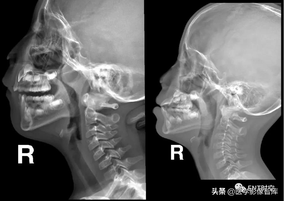 腺样体肥大有必要做x射线复查吗,最简单检测腺样体肥大的方法