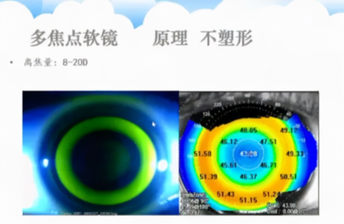 儿童屈光不正配镜专家共识,眼科医生吴夕教授