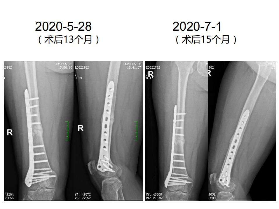 平乐骨科推拿教学,中医治疗骨折畸形愈合