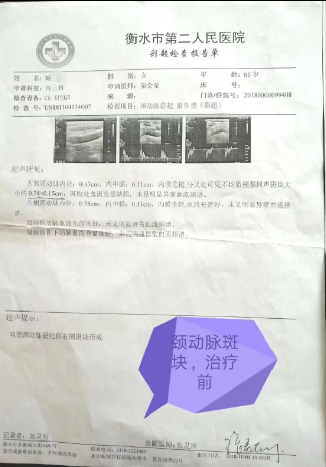 消斑散结治血管斑块中药,消斑溶栓通脉汤处方