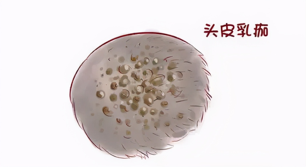 宝宝头皮上乳痂怎么去除,婴儿头皮乳痂是什么引起的