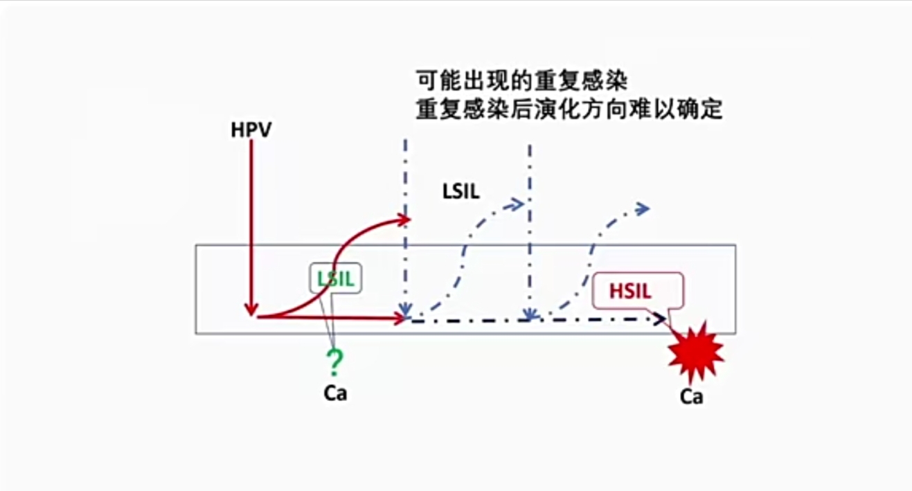 宫颈低级别鳞状上皮病变LSILCIN1,宫颈鳞状上皮内病变lsil是什么