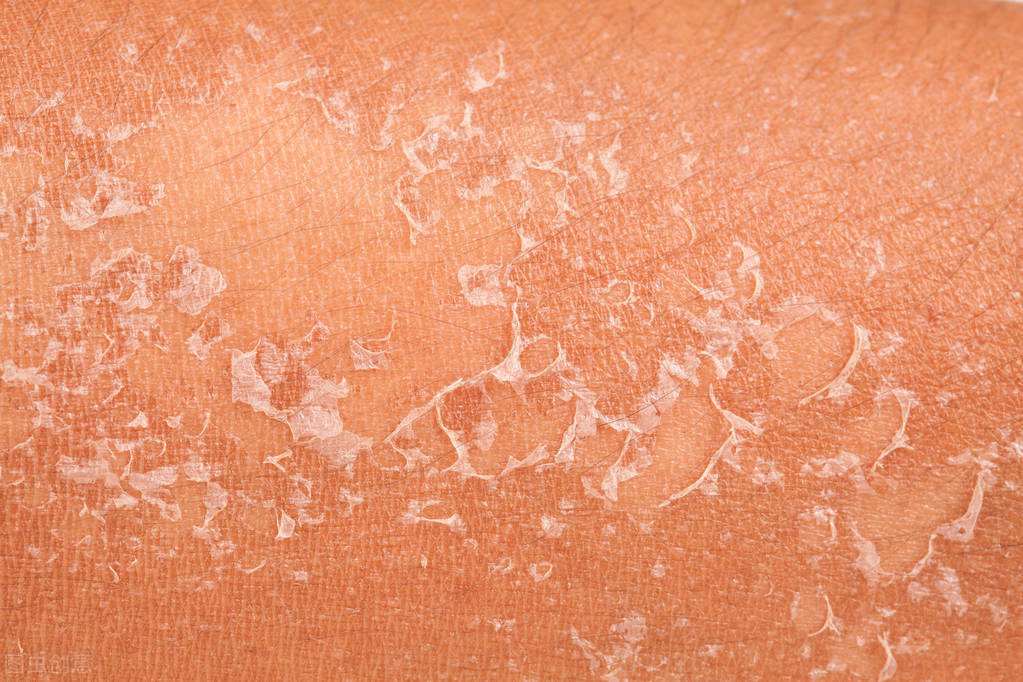 各种皮炎是哪些皮炎呢,得了皮炎需要注意什么