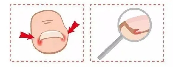 指甲老往肉里长化脓,指甲为什么一直往肉里长