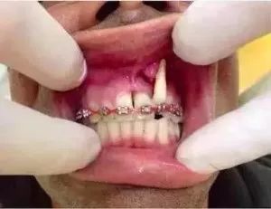 拼多多卖的隐形牙套可靠吗,拼多多上的牙模牙套靠谱吗