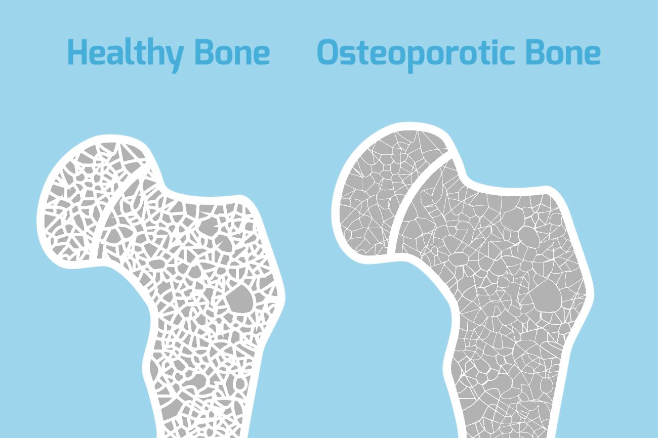绝经情绪低落要怎么调理,女人绝经骨质疏松腰痛到底有多疼
