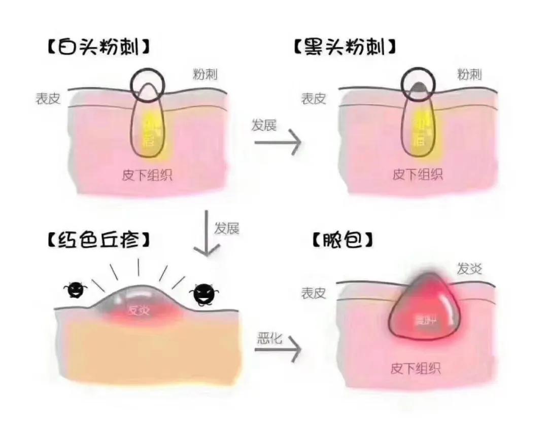 皮肤太油长痘怎么调理,头皮长痘中医怎么调理