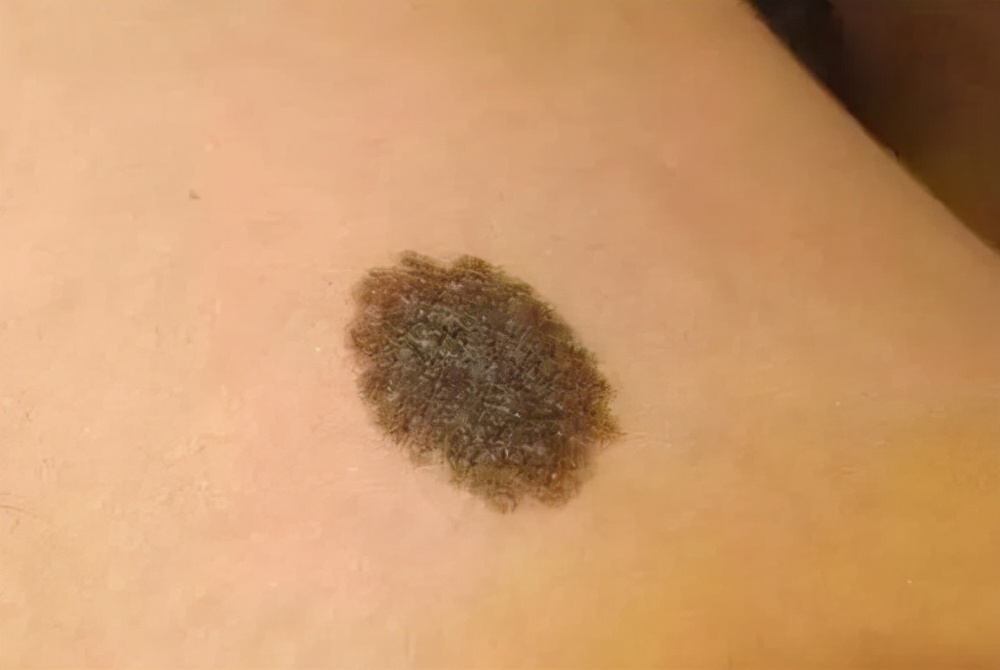 街上点痣10元可靠吗,路边点痣真的可靠吗