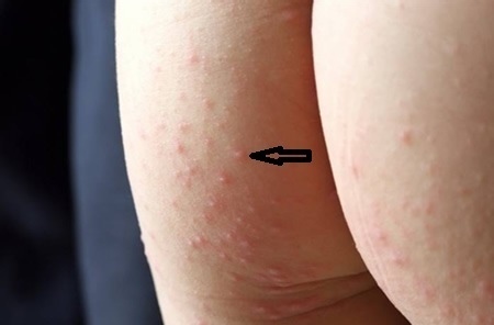 春季手足口病的预防及应急预案,幼儿园春季预防手足口病课程