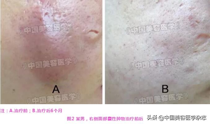 高频电针祛疣,射频火针治疗囊肿痘痘过程