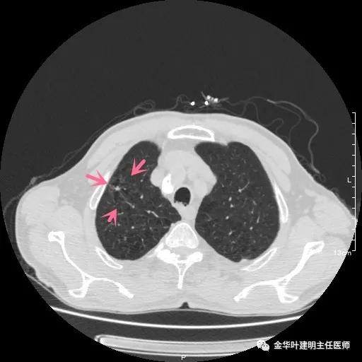 多发原发肺癌能根治吗,肺部原发性恶性肿瘤好治