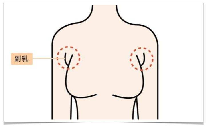 副乳和手臂赘肉怎么遮住,有副乳怎么穿吊带妙招