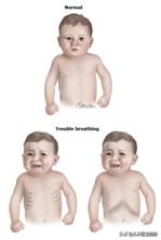 咳嗽咳了很久去医院怎么检查,3岁咳嗽到什么程度要送医院