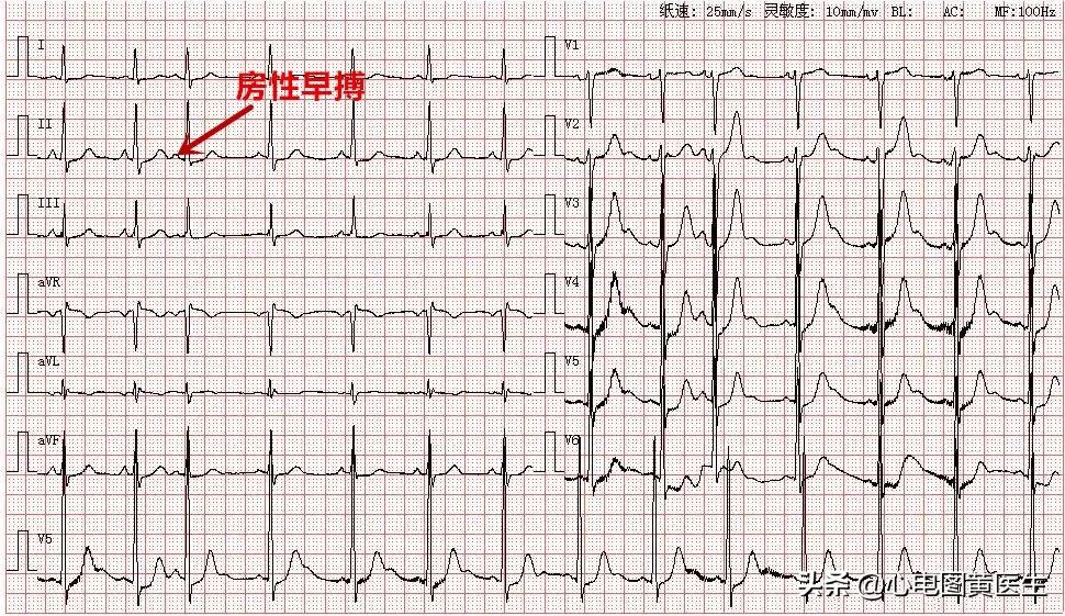 心电图出现qrs电压交替现象,心电图出现u和t波倒置