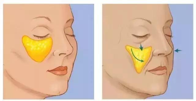 线雕5年后的变化图片,做了线雕以后的注意事项