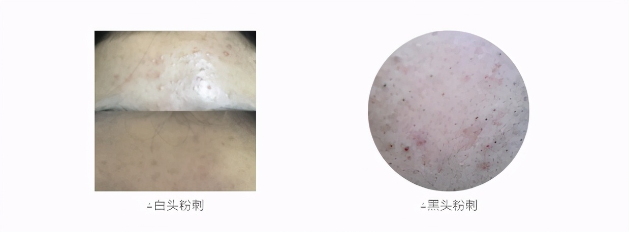 闭口粉刺如何正确护肤,闭口粉刺肌肤怎么护理