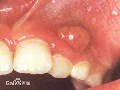 蛀牙不补能不能戴牙套,蛀牙不补认真刷牙可以防止变严重吗