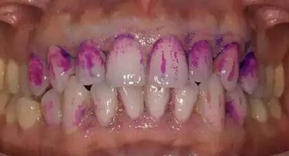 洗牙一般多久洗一次比较好知乎,洗牙多久洗一次好