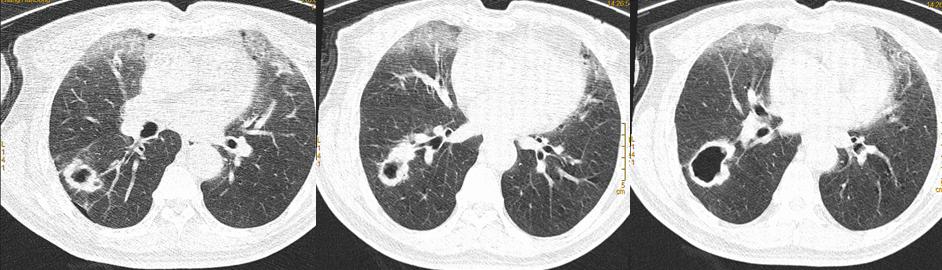 肺鳞癌介入治疗成功率,肺鳞癌最好的免疫化疗方案