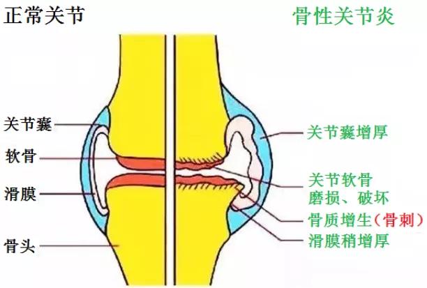 膝关节骨刺疼痛用艾灸有用吗,膝关节骨刺疼痛口服药