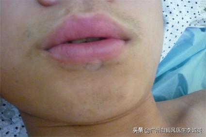 人身上为什么会出现白癜风,肉眼看不到的白癜风是属于什么