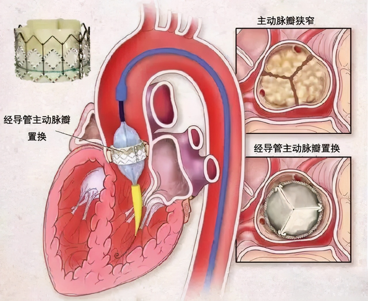 tavr手术华西医院首例,tavr手术国内第一