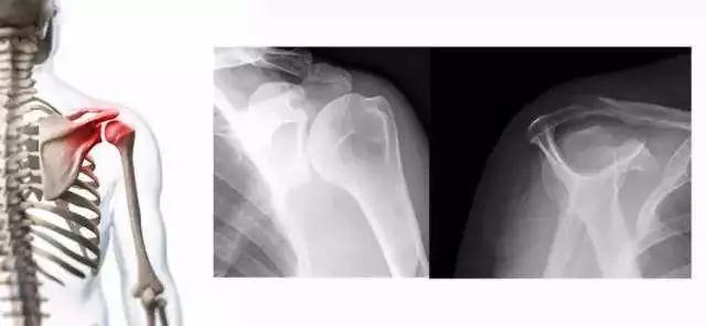 颈椎病肩周炎手臂抬起无力,肩膀疼胳膊抬不起来是颈椎病