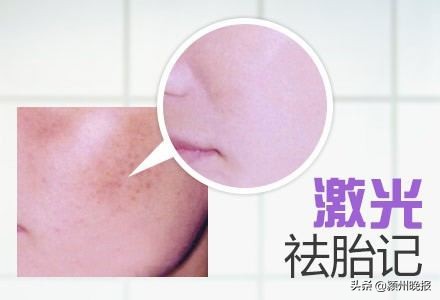 一次激光祛疤多少钱,一次激光治疗疤痕要多少钱