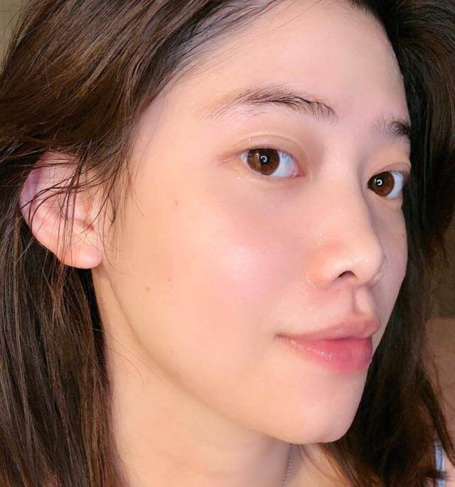 额头闭口和下巴闭口如何去除,下巴长闭口粉刺怎么去除小妙招