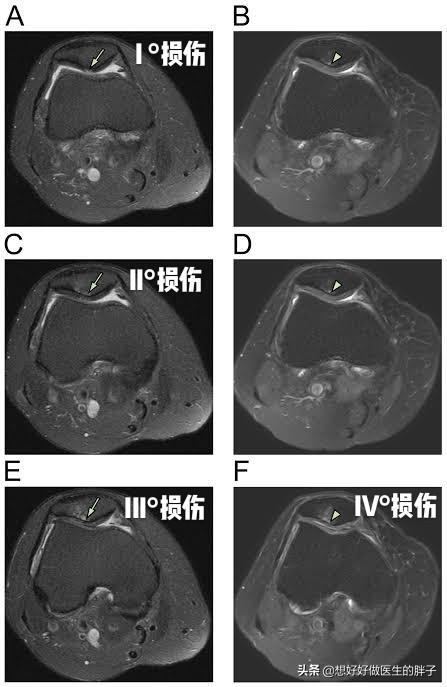走路膝盖会突然软一下就骨折,走路时膝盖突然软一下怎么治