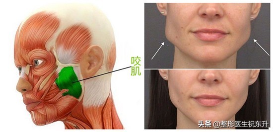 打了三次瘦脸针想告诉你这些真相,刚打了瘦脸针后悔了有补救吗