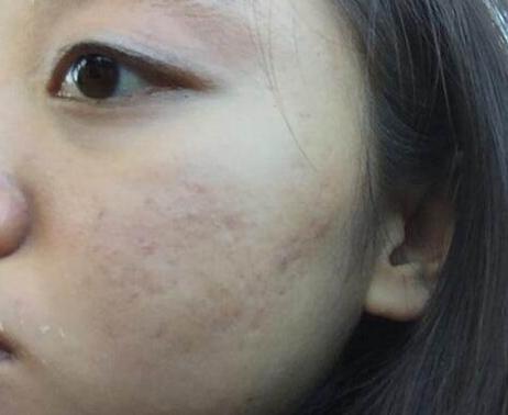 怎样祛痘印方法最有效,怎样祛痘印小妙招视频