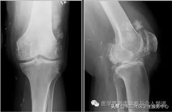 软组织钙化是不是骨化性肌炎,软组织钙化或骨化