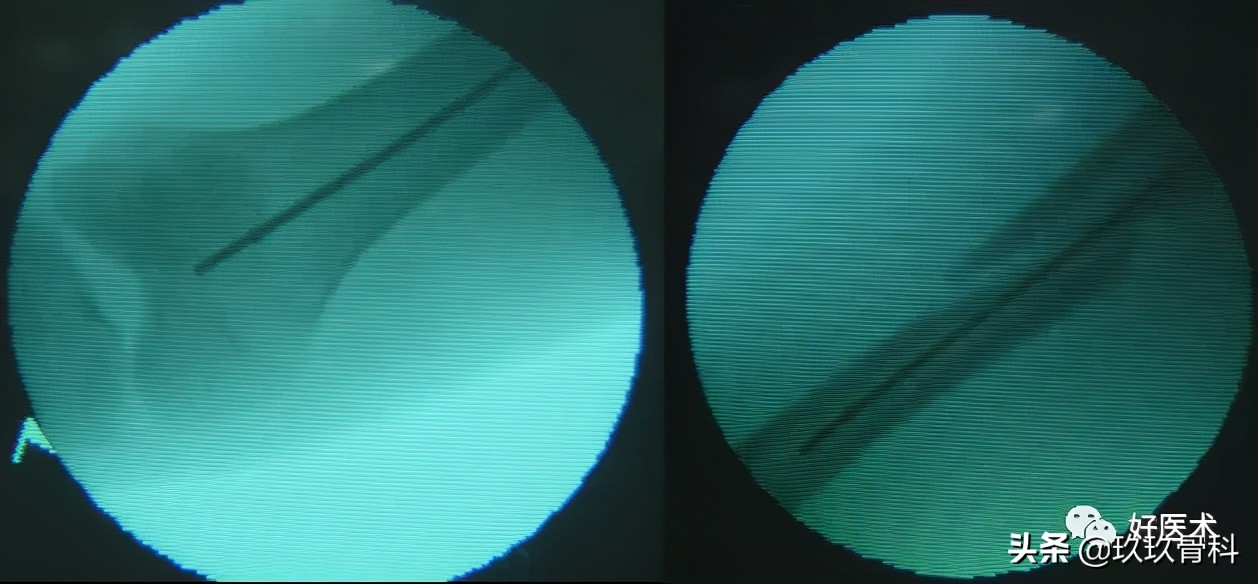 髓内钉技巧,髓内钉教学视频讲解