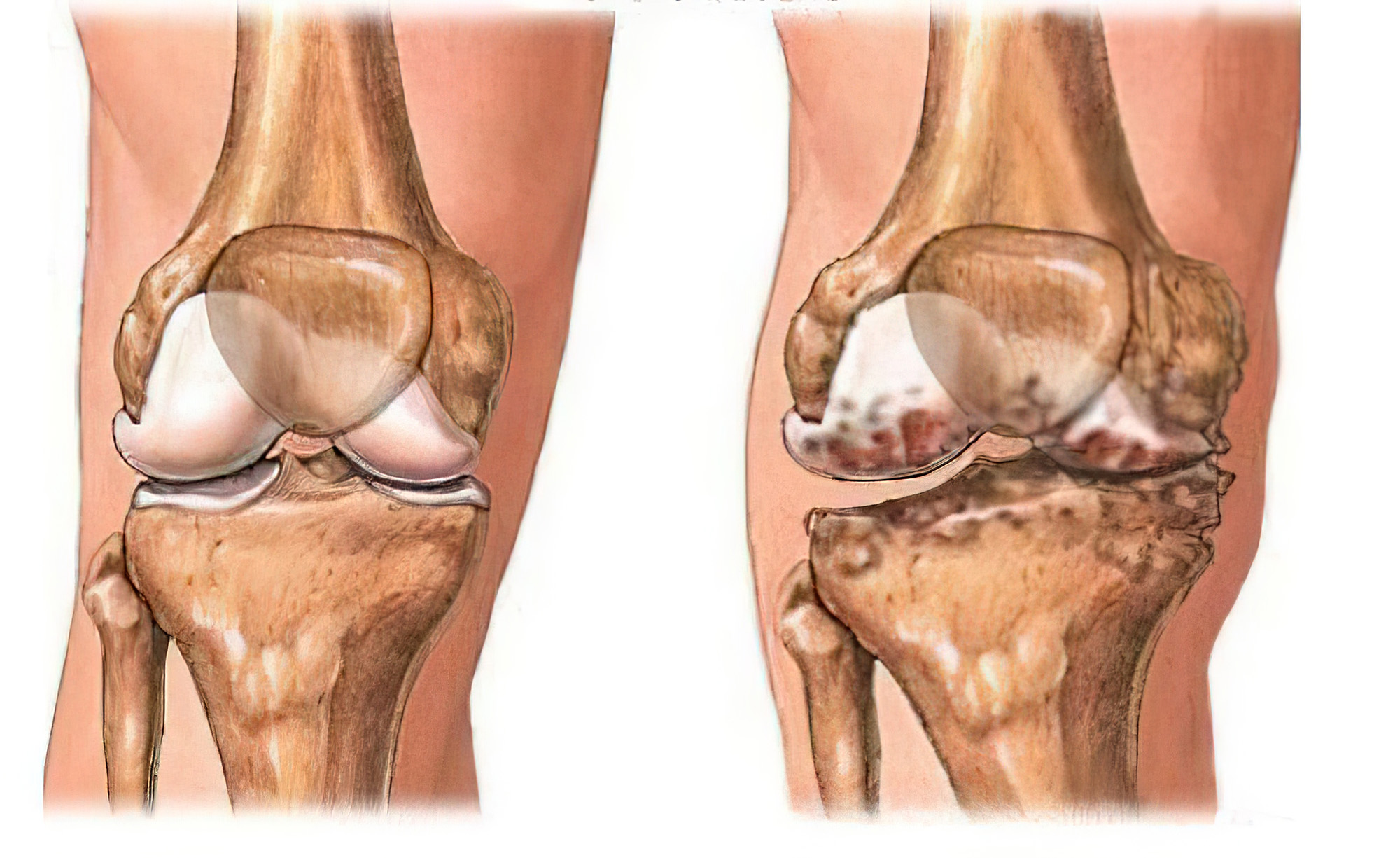 打封闭针可治骨关节炎吗,骨刺关节炎怎么治疗效果最好