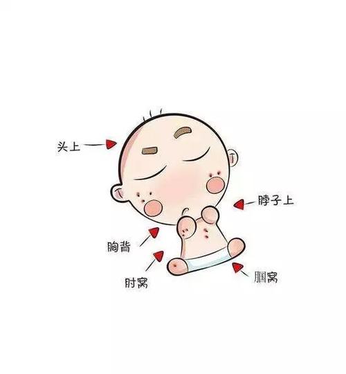 怎么预防宝宝热痱子,夏季宝宝防痱子护理秘诀请收藏