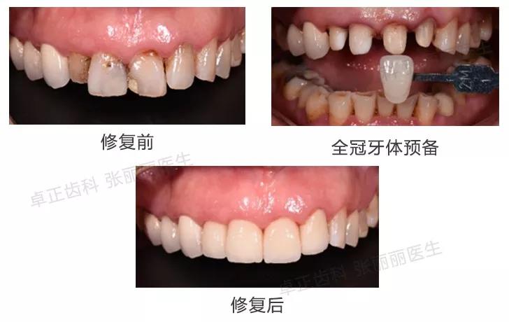 牙齿楔状缺损修复视频,牙齿缺损了可以选择哪些修复方式
