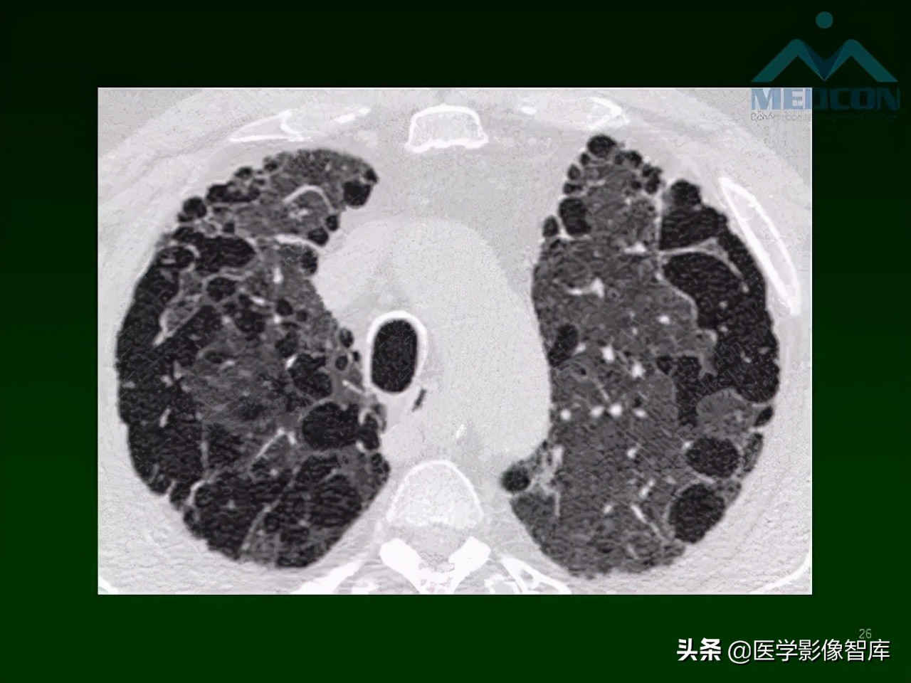 肺弥漫性网状影,两肺小叶间隔增厚可见网状模糊影