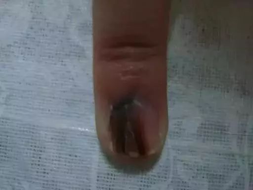 指甲全是竖条纹和白点是怎么回事,指甲竖条纹没有月牙怎么回事