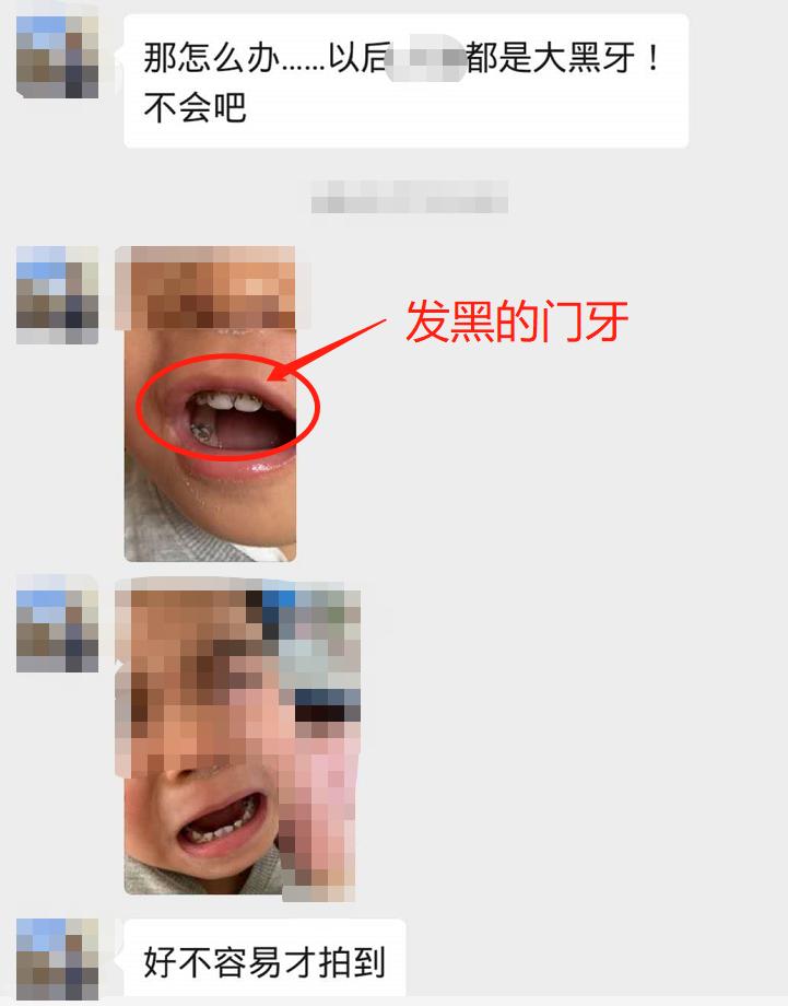 宝宝门牙发黑怎么根管治疗,宝宝门牙变黑是什么原因
