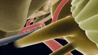 痛得拔光一排牙！解决炸裂“天下第一痛”一根套管针显乾坤