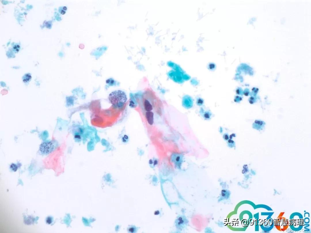 病理宫颈活检lsil是什么意思,宫颈病理检查与tct检查的区别