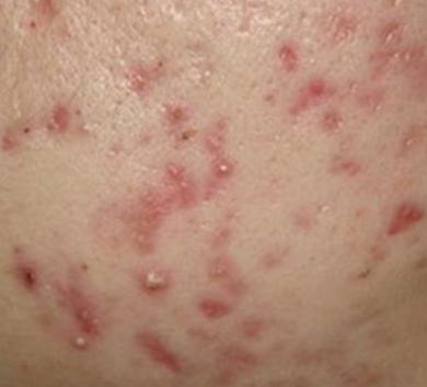 崔雪莉抑郁自杀,英国伯奢BOXURY发现痘痘竟然也能引发抑郁