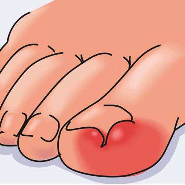 甲沟炎怎么初期治疗才能彻底根除,甲沟炎患者有多痛苦