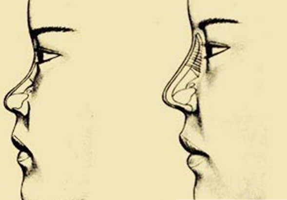 “女看眼，男看鼻”，塌鼻梁的男生如何改善？