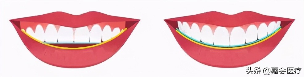 成年还可以做牙齿矫正吗,多大年纪就不能做牙齿矫正了呢