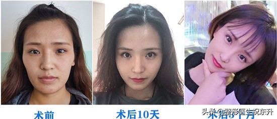 面部皮肤松弛下垂怎么改善,面部皮肤松弛下垂怎么恢复