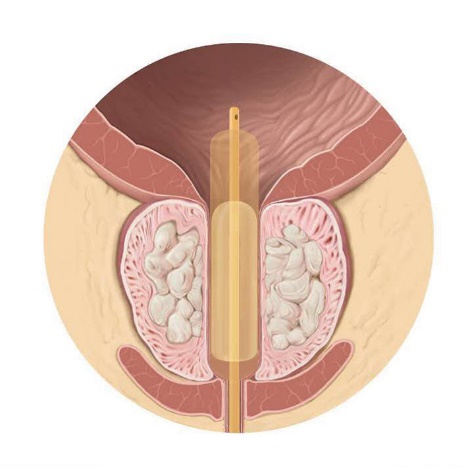 明明有尿意却拉不出来怎么办,明明有尿急却尿不出来