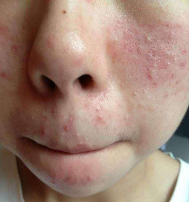 脸上有螨虫很痒怎么治,感觉脸上螨虫在动