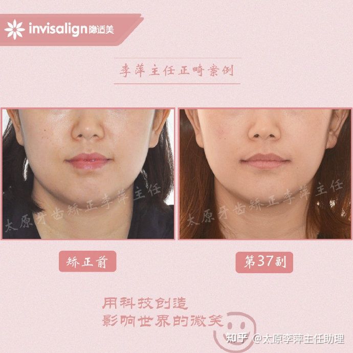 重度拥挤矫正牙齿适合隐形牙套吗,广州成人牙齿矫正推荐隐形牙套